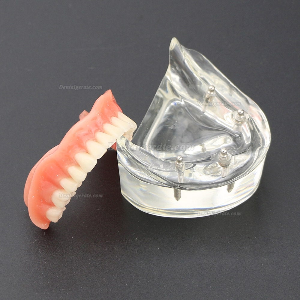 Dental Lower Z&auml;hne Demo-Studienmodell 6002 02 Overdenture Unten 4 Implantate